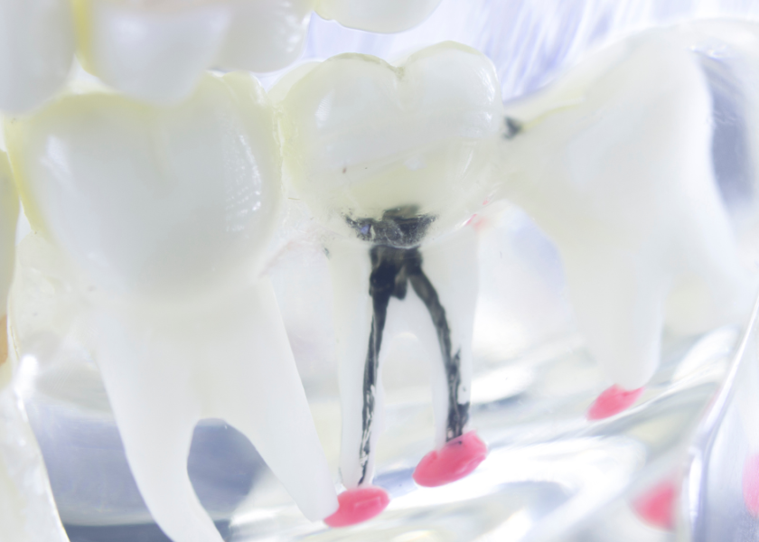 what is a root canal treatment and why you may need it?