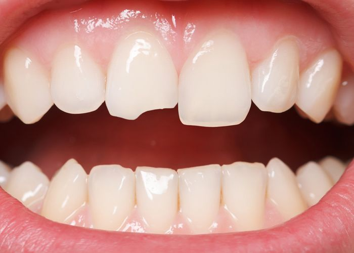 why you shouldn’t just ignore your chipped tooth