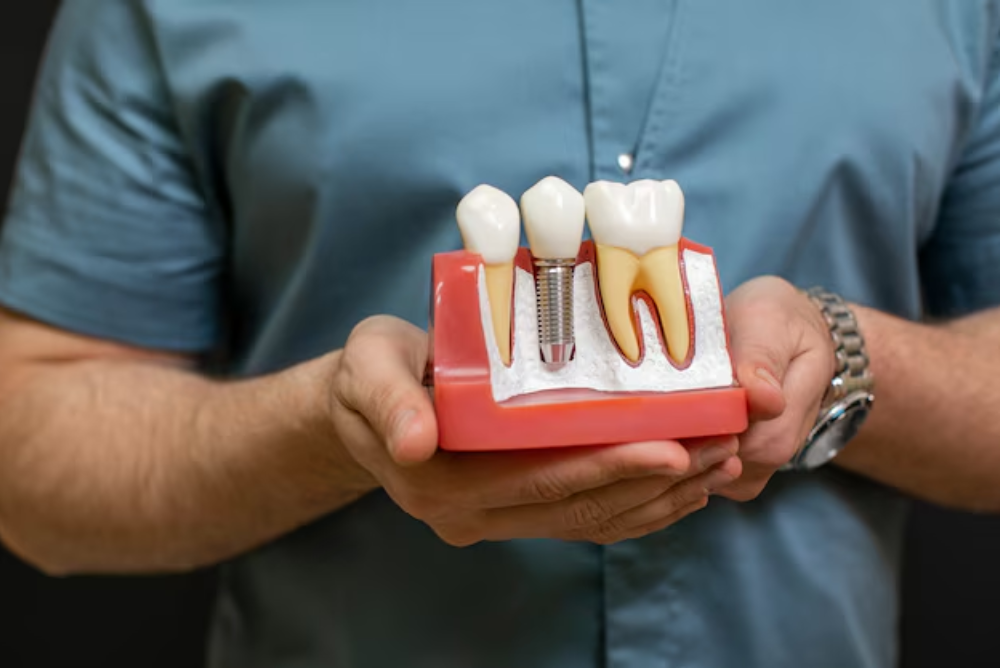 Which Is Better, Titanium Or Ceramic Dental Implants?